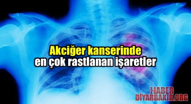 Akciğer Kanseri Nedir